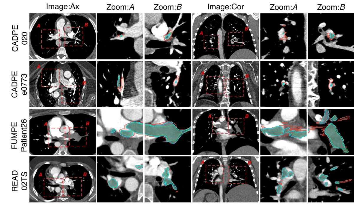 Visual comparison of original and refined PE masks with STAPLE consensus. For each case, the same PE is displayed in the axial and coronal planes; the leftmost image of each plane shows the whole slice, and the two adjacent panels (Zoom: A, Zoom: B) magnify the two regions of interest outlined by the red dashed boxes labeled A and B on the full image. Overlays: original annotation (red), Annotation 1 (green), and STAPLE consensus of Annotation 2–4 (blue). Ax = axial, Cor = coronal.