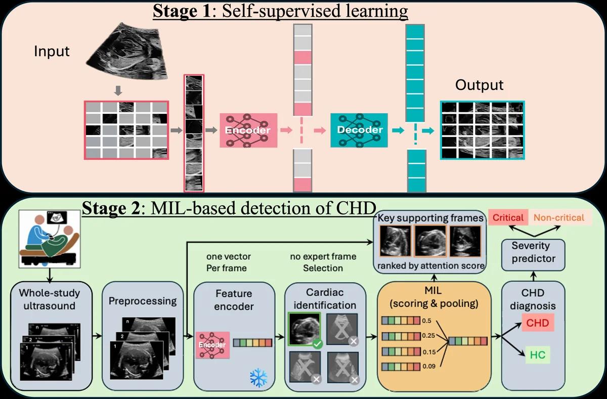 Overview of the proposed two-stage framework. Stage~1: self-supervised pre-training of the frame encoder with a masked-autoencoder objective on unlabeled fetal ultrasound frames. Stage~2: MIL-based CHD detection. A whole-study ultrasound is preprocessed, every frame is embedded by the pre-trained encoder, which is kept frozen (snowflake) and yields one vector per frame; the cardiac-frame identification module passes only the features of the frames it identifies as cardiac, and a transformer aggregator with a classification token pools them into a study representation. A diagnosis head predicts CHD versus HC, a hierarchical severity head, trained as a separate branch, separates critical from non-critical CHD among predicted CHD cases. The attention from the classification token to each frame ranks the key supporting frames returned for clinician review. No expert frame selection is required at any point.